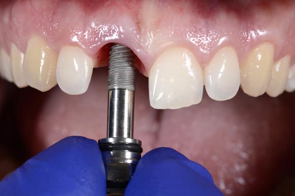 Auge del negocio de implantes dentales